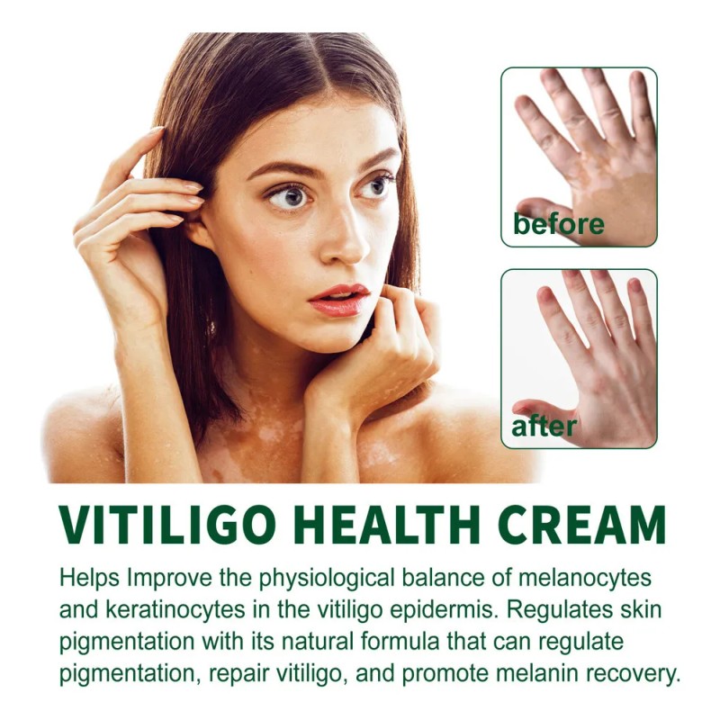 Vitíligo Aceite White Vitíligo Para 4×crema T