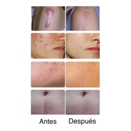 DOREAN Eliminador De Cicatrices Espinillas Estrias Y Varices