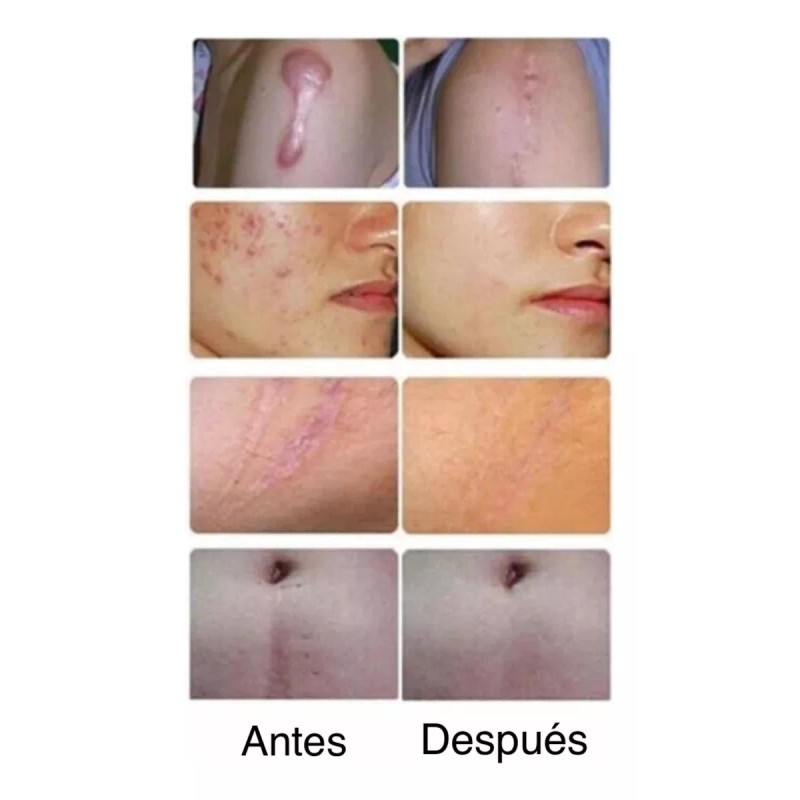 DOREAN Eliminador De Cicatrices Espinillas Estrias Y Varices