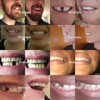 Smilogic Temporary Tooth - DIY Dentures Set - Replace Yourself