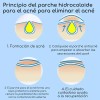 Pack de Parches para Acné AuraLux con Hidrocoloide y Ácido