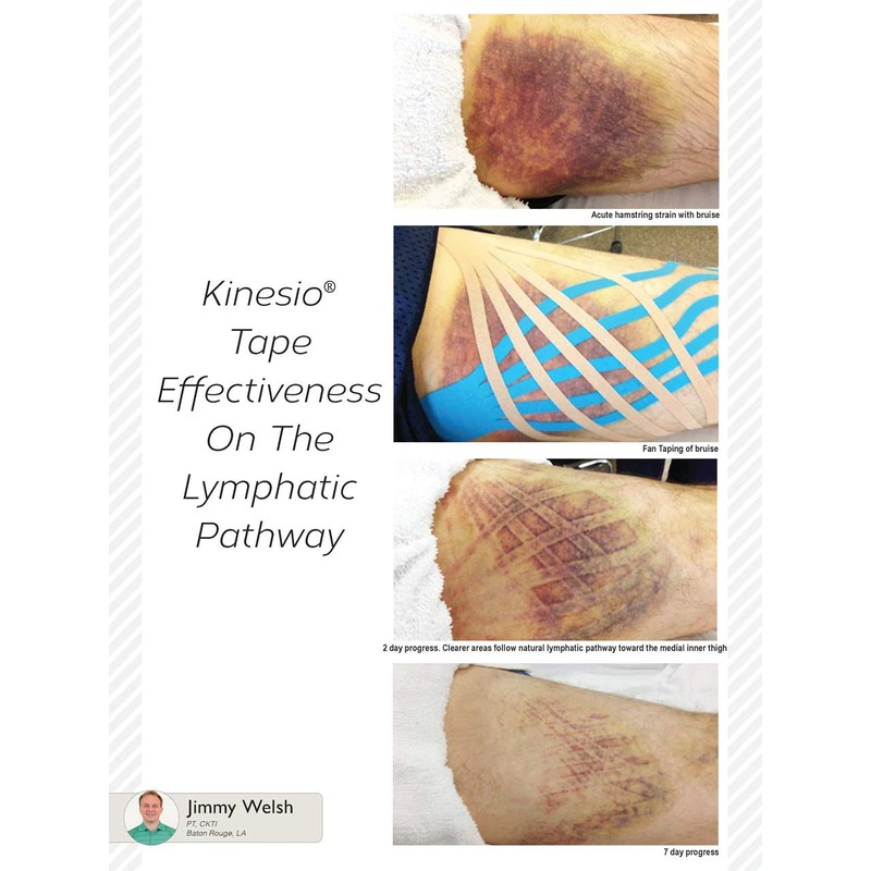 Kinesio Classic Fan Cut Edema Strips 12 Pack