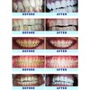Crystal Clear Teeth Whitening Kit de Gel Blanqueador de Dientes