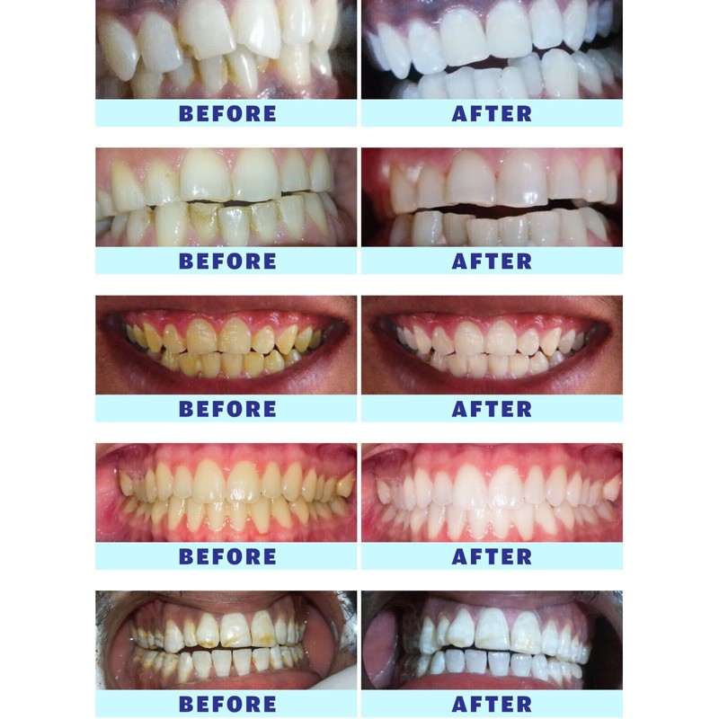 Crystal Clear Teeth Whitening Kit de Gel Blanqueador de Dientes