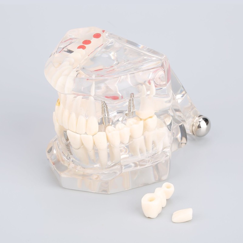Detachable Dental Model Dental Disease Teaching Study Typodont Demonstration Tooth