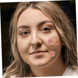 TOVINANNA 2pcs Invisible Hydrocolloid Pimple Patches Stickers for Treatment Breathable and Comfortable for Daily Use for All Skin Types