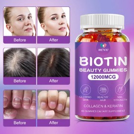 MENXI Vitamatic Biotin Gummies 12000Mcg for Stronger Hair Skin Nails 120 Vegan Gummies