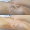 (Domestic) Siarte Sugar Waxing Self-Waxing Set Brazilian Underarm Arm Leg,
