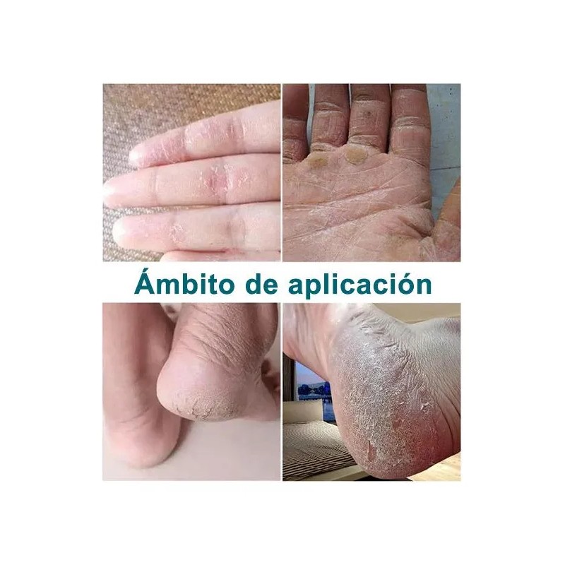 Artken Reparación Para Pies Agrietados Y Resecos - Crema T