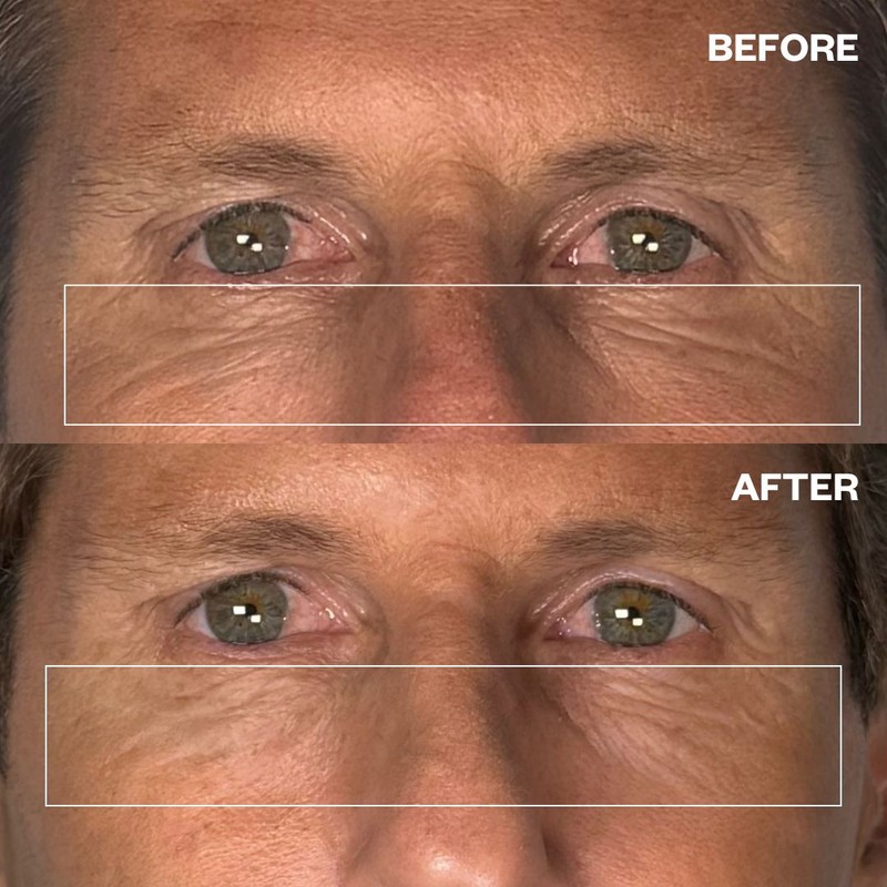 Wrinkles Schminkles Men's Pro Eye Wrinkle Patches - 3 Pairs