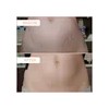 B-flat Crema Reafirmante Para Estras De Celulitis, Tratamien