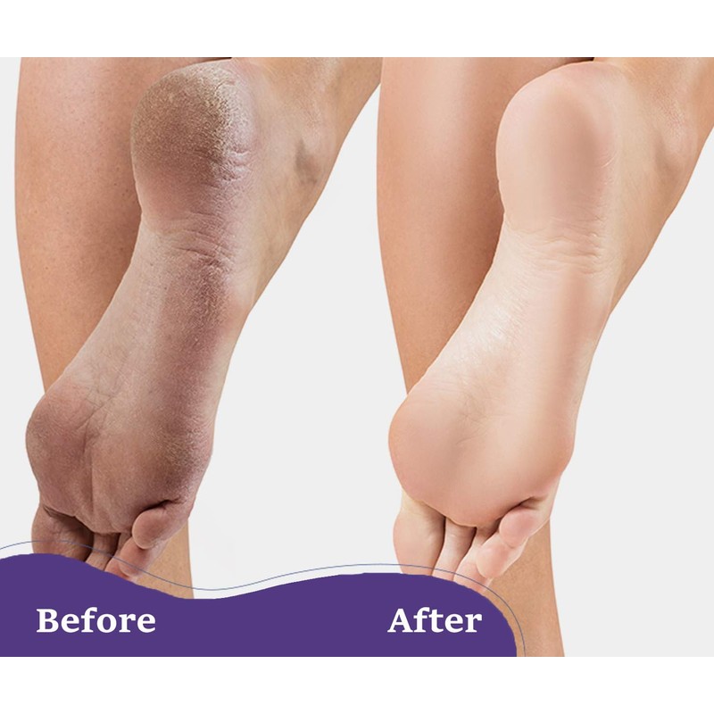 6 Packs Foot Pumice Stone, Double Sided Foot Scrub for