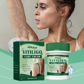 Vitiligo Cream, Natural Effective Vitiligo Treatment for Reduce White Spots and Improve Skin Pigmentation - Volume: 30g