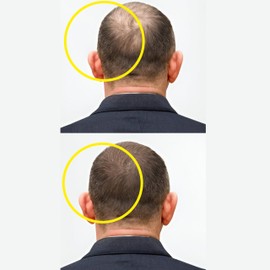 Masofta Hair Growth Serum For Promoting Hair Growth & Controlling Hair Fall With 3% Redensyl, 5% Capixyl, 4% Anagain, 3% Procapil & Rosemary & Biotin, For Both Men & Women, 50 ml (Pack of 1) White