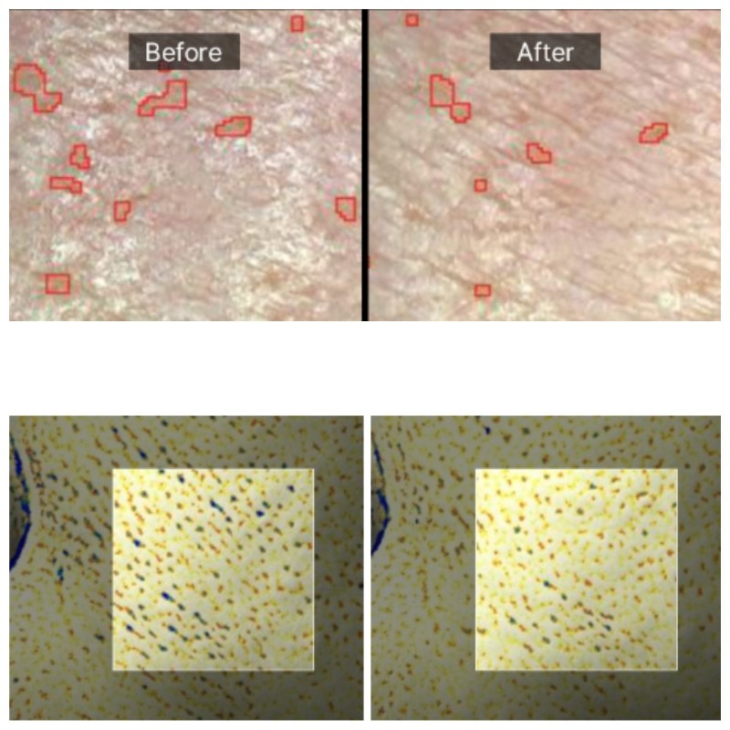 AROCELL TXA Mask + Super Collagen Mask + Botulcare Mask