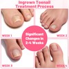 Ingrown Toenail Removal Kit Professional Ingrown Toenail Tool Kit with