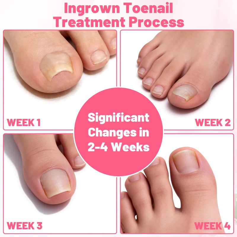 Ingrown Toenail Removal Kit Professional Ingrown Toenail Tool Kit with