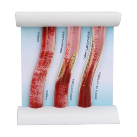 Lipoprotein LDL Blood Vessel Model Low Density Blood Lipid Vessel Obstruction Model for Education