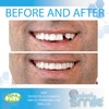 Instant Smile Themal Fitting Temporary Tooth Replacement Fitting Beads