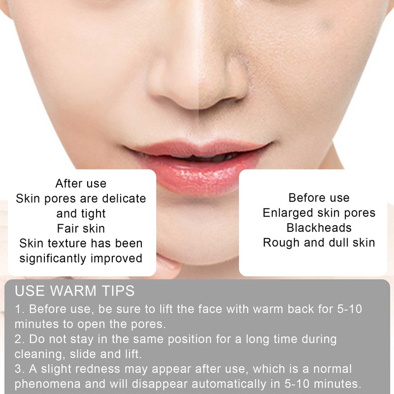 Electric Hot Compress Blackhead Acne Removal Machine Face Pore Cleaner