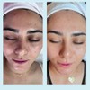 Salicylic Acid 20% Gel Peel - Enhanced with Tea Tree