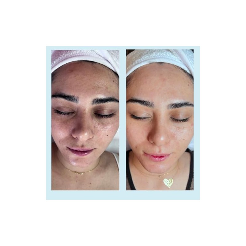 Salicylic Acid 20% Gel Peel - Enhanced with Tea Tree