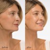 MAREE Mascarilla Lifting V Line con Ácido Hialurónico Mascarilla Facial