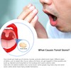 Tonsil Stone Remover and Oral Hygiene, Led Tonsil Stone Pick