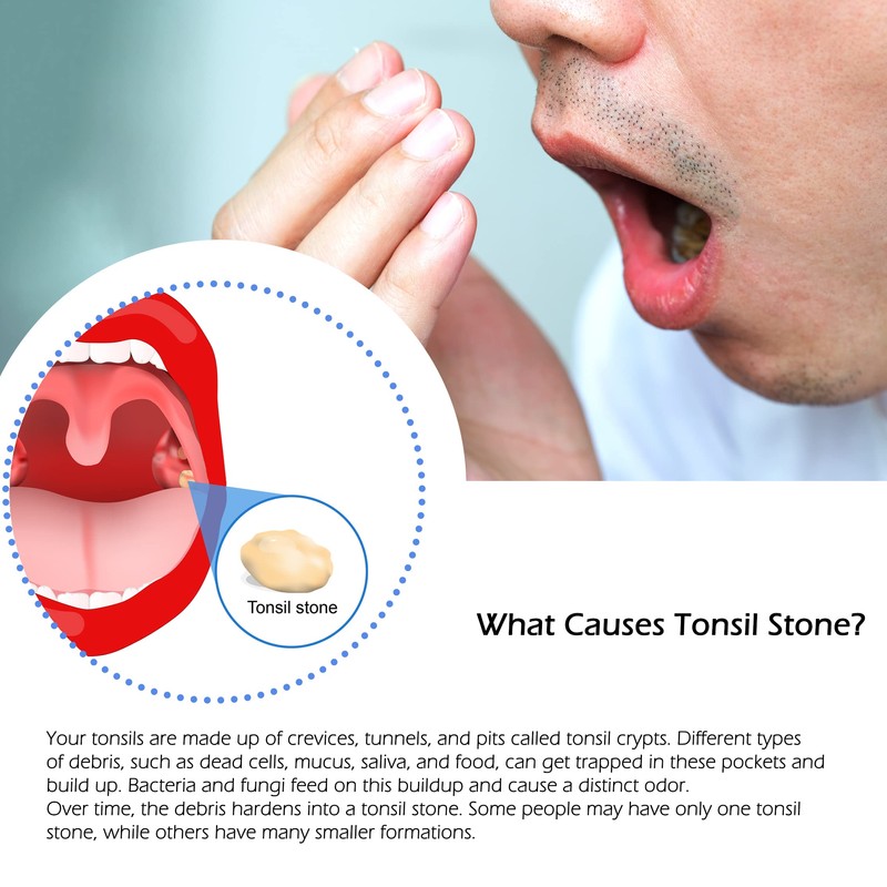 Tonsil Stone Remover and Oral Hygiene, Led Tonsil Stone Pick