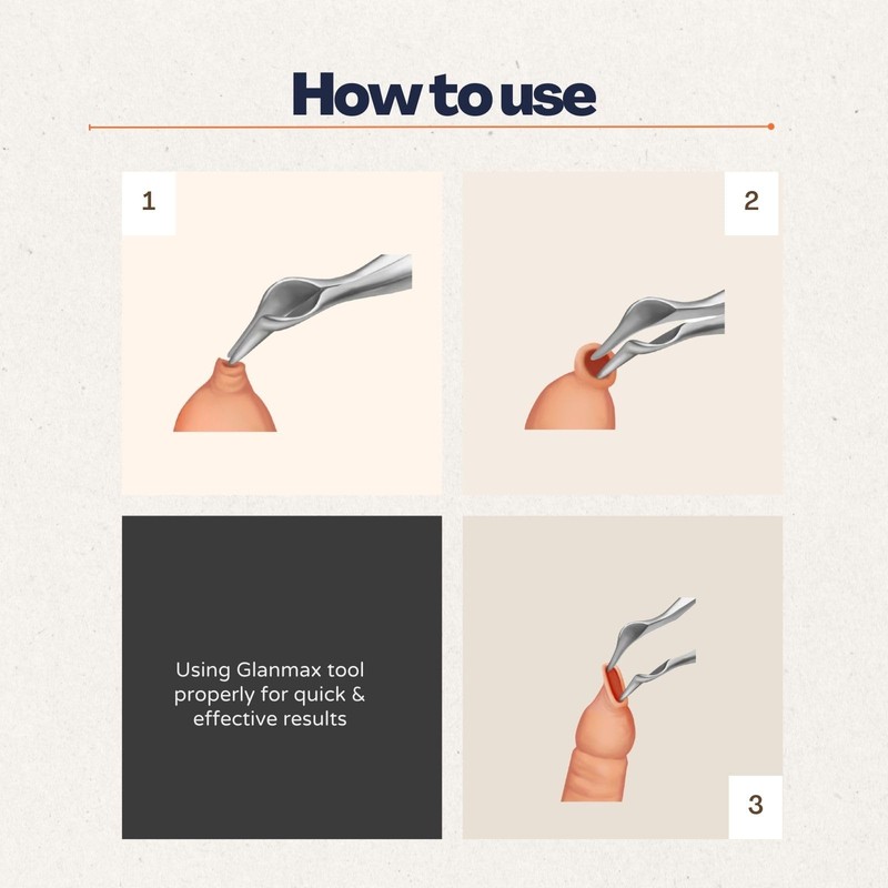 GlanMax tool for phimosis | Phimosis Stretching tool | Opens