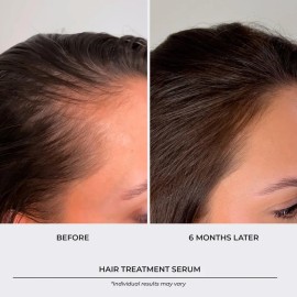Sérum Para El Crecimiento Del Cabello, Espesante Para Folícu