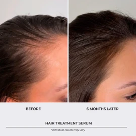 Sérum Para El Crecimiento Del Cabello, Espesante Para Folícu