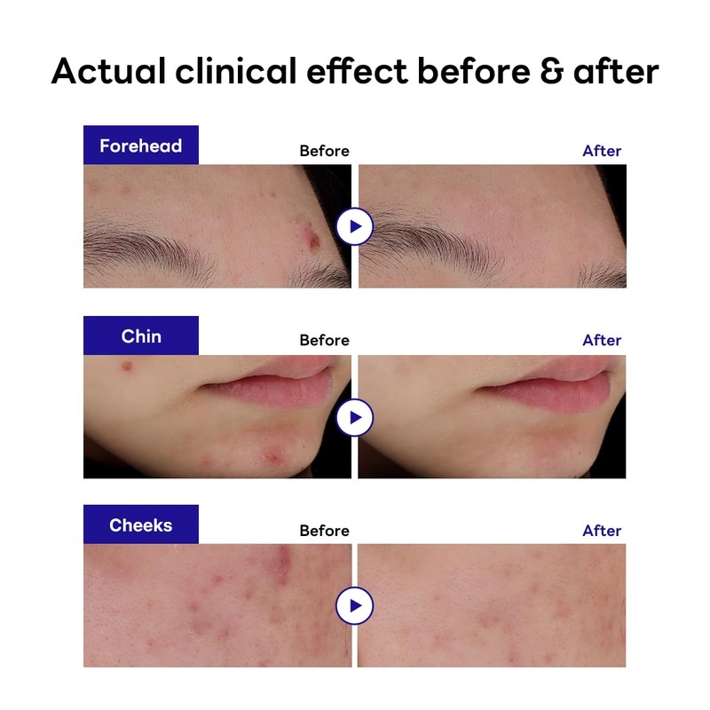 Mediheal Derma Clear Madecassoside Blemish Spot Patch (44 Counts) -