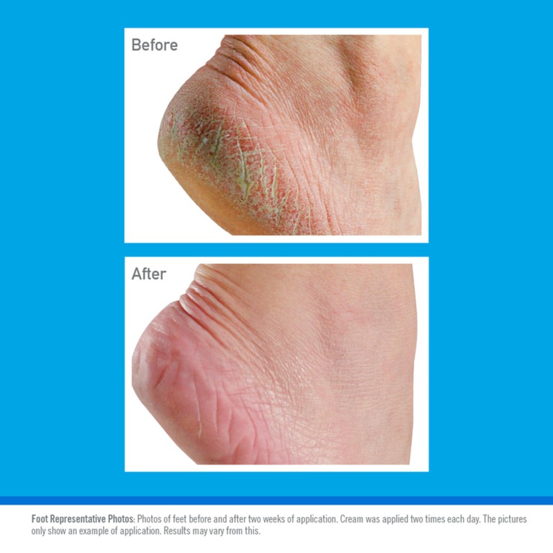 O’Keeffe’s® Healthy Feet Jar 91g 6 Pack