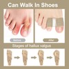 Pack of 4 Toe Separators Hallux Valgus Hallux Valgus Correction