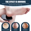 Callus Remover, Callus Remover Foot - Removes Calluses and Calluses