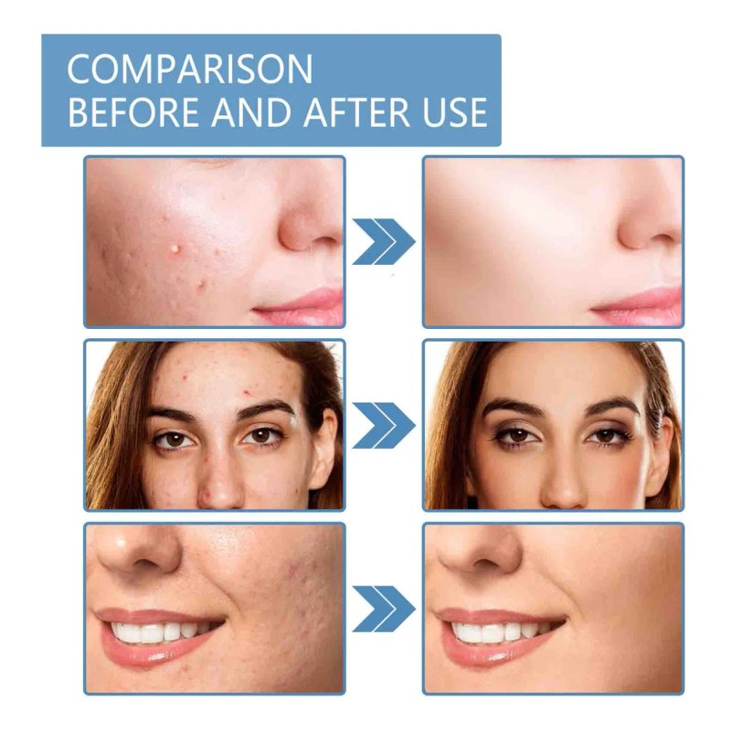 Gel Retinoide Tópico Para El Tratamiento Del Acné