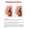 ORGANIC VITAMINS QUISTE TESTICULAR ROMOVEDOR - NO MAS DOLOR -