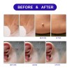 180 Pimple Patches Discretos Comodos Acné Verrugas Mezquinos