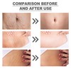 Silicone Patches for Stretch Marks, Anti Wrinkle Stretch Removal Sheet