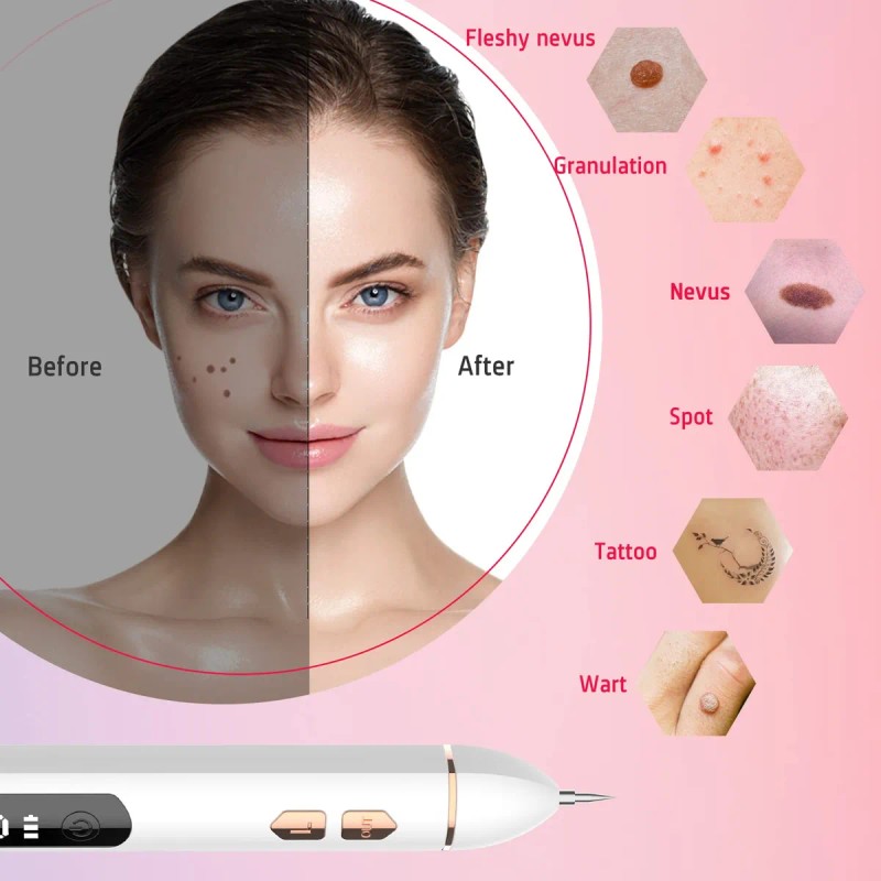 Cauterizer De Verrugas Pecas Lunares, Plumón Quita Verrugas