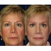 Retinol + Collagen, Hyaluronic Acid, Vitamin C AntiAging Wrinkle Serum