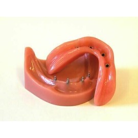 DENTAL IMPLANT 0-RINGS