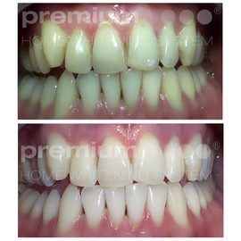 Premium Home Teeth Whitening Kit