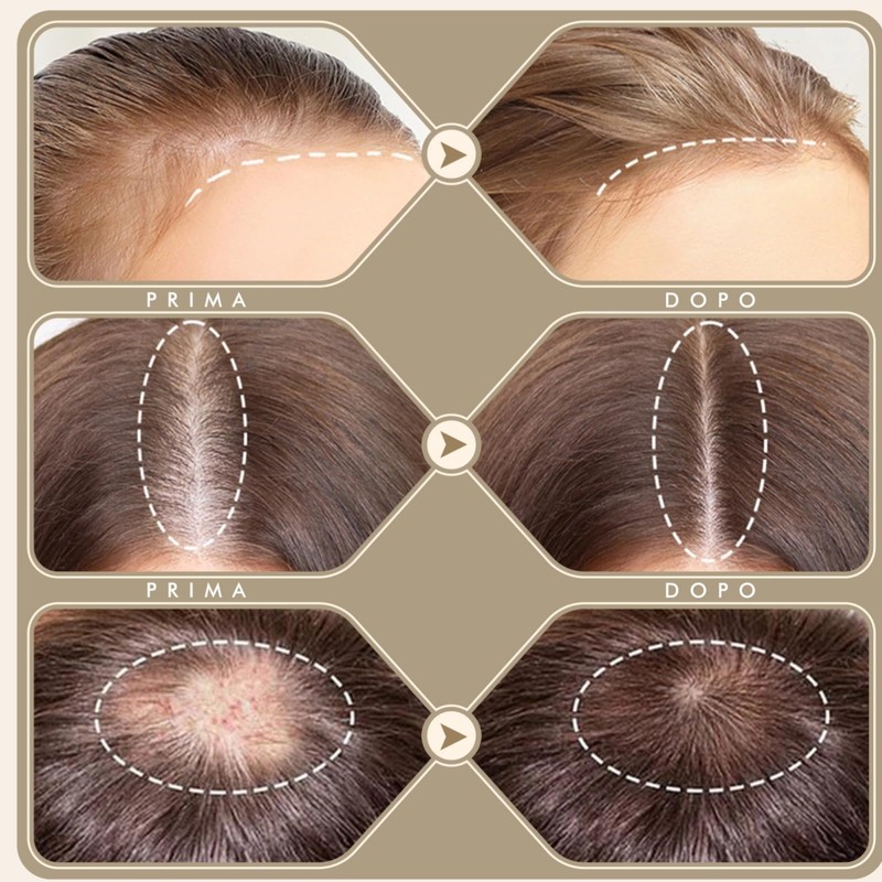Derma Stamp, Dermastamp Regolabile 0-3mm 120 Titanio Aghi + 64