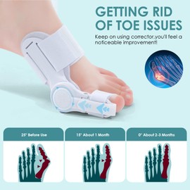 Asfacuputure Hallux Valgus Correction, Adjustable Hallux Valgus Correction, Hallux Valgus Correction for the Big Toe, Support for Hallux Valgus and Bunion Correction for Men and Women