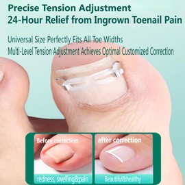 Professional Ingrown Toenail Corrector Kit - Curved Nail Strips & Toe Pads for Embedded/Curled Nails