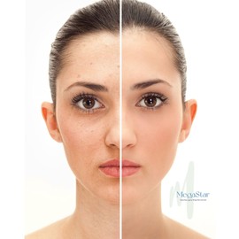 Parches Hidrocoloides para Acné 72 Piezas, Discretos y Efectivos, Ingredientes Naturales, Para Espinillas, Granos, Piel Sensible y Grasa, Antiacné