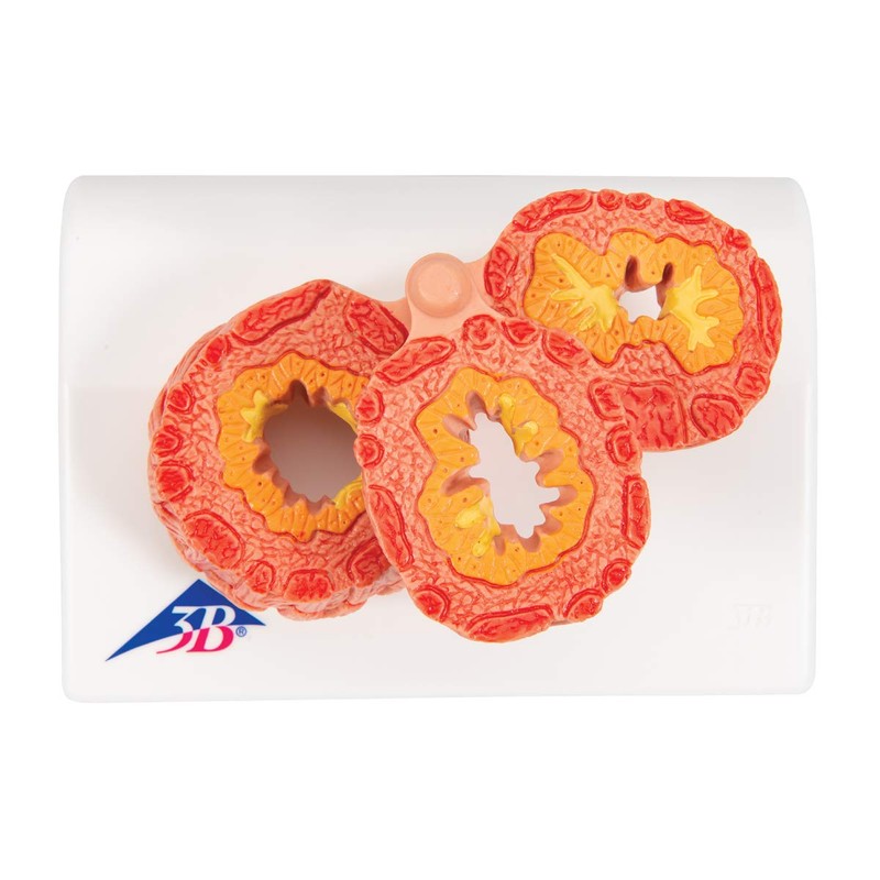 3B Scientific Human Anatomy - COPD Model + Free Anatomy