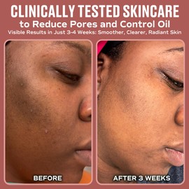 ADM Anti Aging Pure Retinol Serum For Face with Niacinamide - Resurfacing, Smoothing Fine Lines, Wrinkles, Acne Scars - Moisturizing Facial Skincare Treatment for Sensitive Skin - 1oz